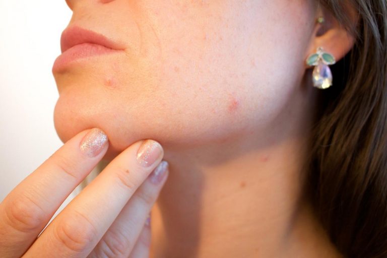 Acne and its treatment